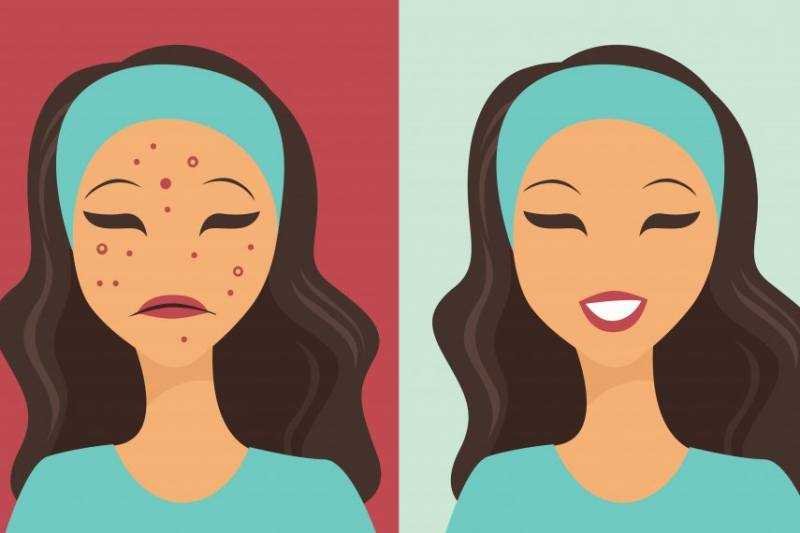 3 receitas praticas para acabar com a acne