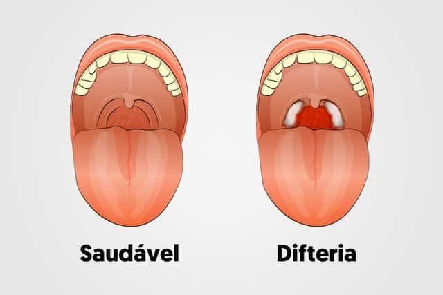 o que é a difteria?