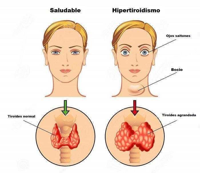 8 sinais de disfunção na tireoide e que 25 milhões de pessoas ignoram