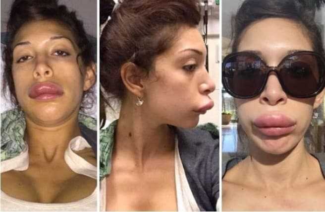 Atriz fez cirurgia para ter labios da Angelina Jolie, mas ficou a cara da Leela do Futurama! d