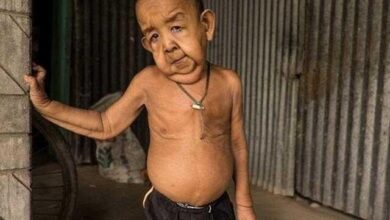 Menino de 4 anos com aparência de idoso abandona escola por causar medo — Bau das DICAS