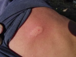1514042729 353 foi picado por algo e nao sabe o que e aqui nos dizemos como identificar as 8 picadas mais comuns