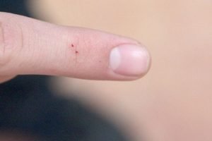 1514042728 230 foi picado por algo e nao sabe o que e aqui nos dizemos como identificar as 8 picadas mais comuns
