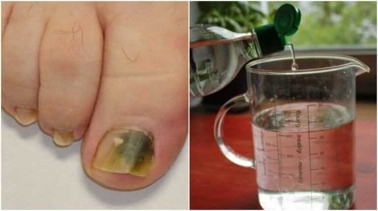 Água oxigenada para prevenir fungos das unhas fr