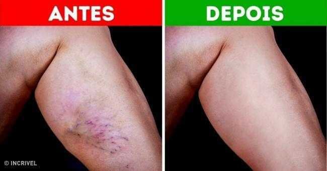 Confira 4 remédios naturais para as varizes q