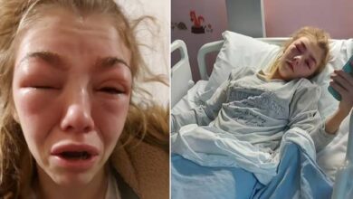 'i was screaming in pain': girl, 14, 'almost loses eyesight' after severe allergic reaction to eyebrow treatment