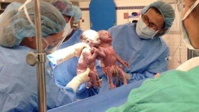 Veja como estão as gêmeas que nasceram de mãos dadas ha 2 anos