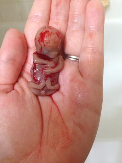 mulher sofre aborto espontaneo e posta foto do bebe de 11 semanas com uma mensagem chocante veja