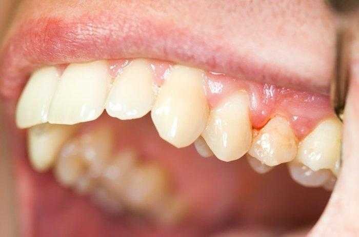Remédios caseiros para a inflamação das gengivas