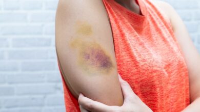 Roxo na pele do nada pode ser um alerta de saúde