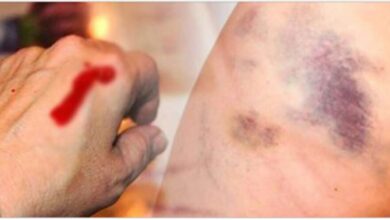 15 Sinais E Sintomas De Leucemia Pouco Conhecidos
