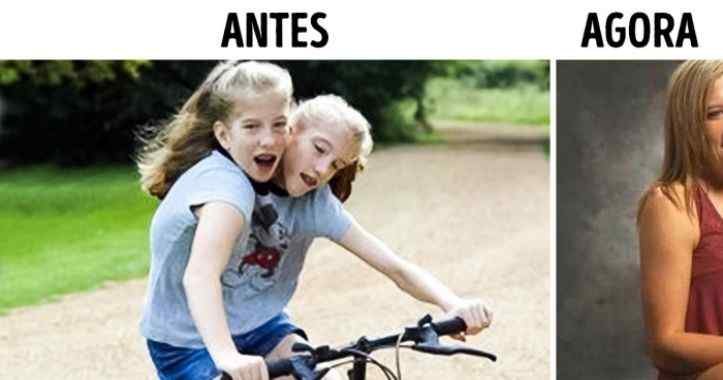 Como estão as irmãs siamesas mais famosas do mundo: “Abby e Brittany”