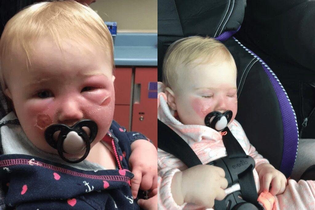 Bebê tem grave queimadura causada por 1 protetor solar e mãe alerta