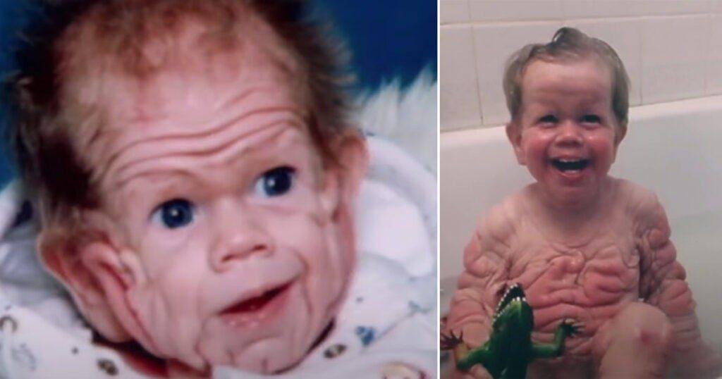 Lembra dele? 'Menino mais enrugado do mundo' está com 28 anos e virou um belo rapaz