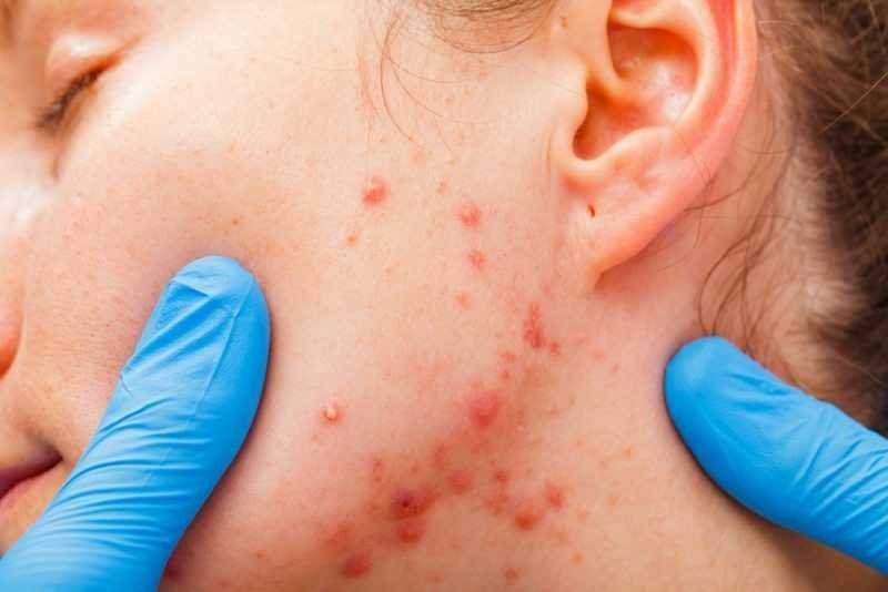 benefícios do zinco para acne benefícios do zinco para acne