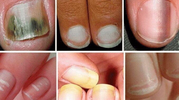 Suas unhas se encontram com algum destes aspectos? CUIDADO para o que pode significar