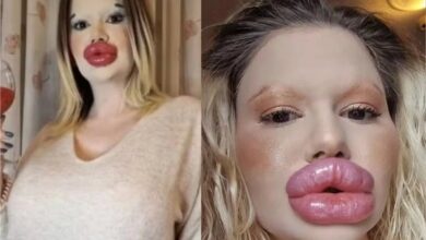 Mulher com os ‘maiores lábios’ do mundo quer passar por outra transformação