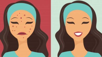 3 receitas praticas para acabar com a acne