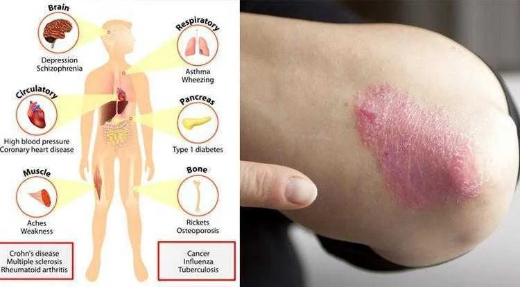 5 sinais de deficiência de vitamina d que não devemos ignorar!