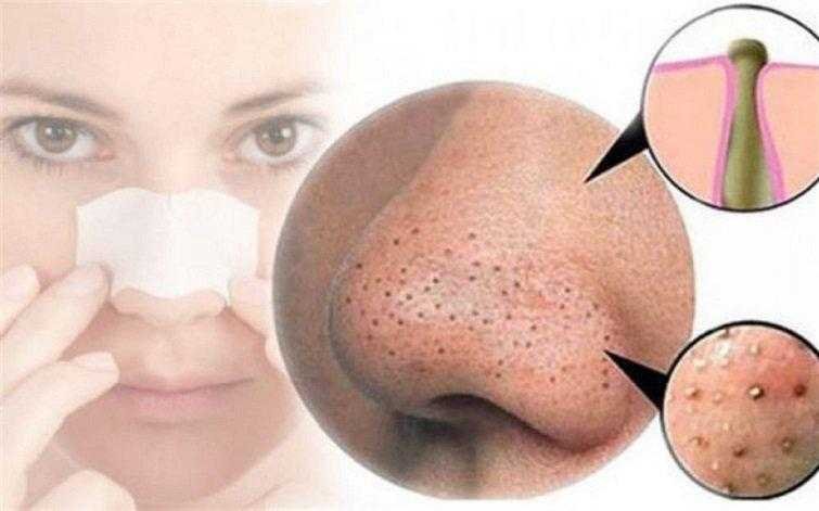 5 máscaras faciais para remover os cravos A