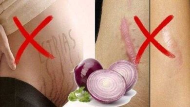 Cebola para eliminar estrias e cicatrizes