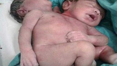 Grávida Acreditava Esperar Gêmeos, Mas Bebê Nasce Com Duas Cabeças • Bau Das DICAS