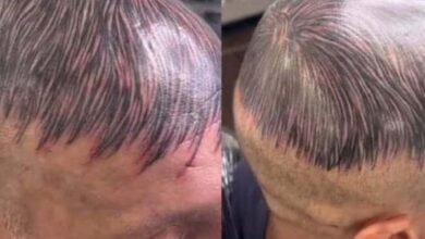 Homem desesperado por sua calvície tatua a cabeça