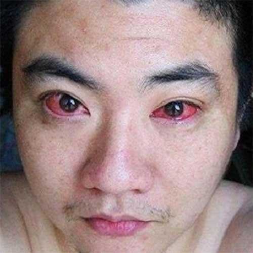 Homem é diagnosticado com câncer nos olhos por algo simples que quase todos fazemos a noite td