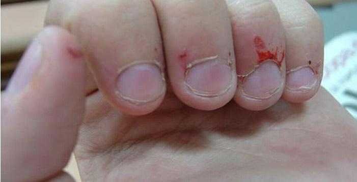 Onicofagia: Compulsão em roer unhas é sinal de preocupação