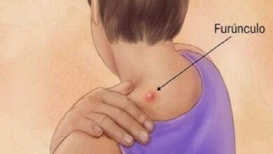 Receita para você tratar furúnculo em casa