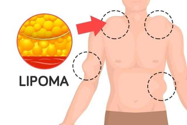 Saiba o que é Lipomatose f