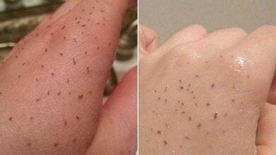Truque simples para remover cravos com pasta de dente