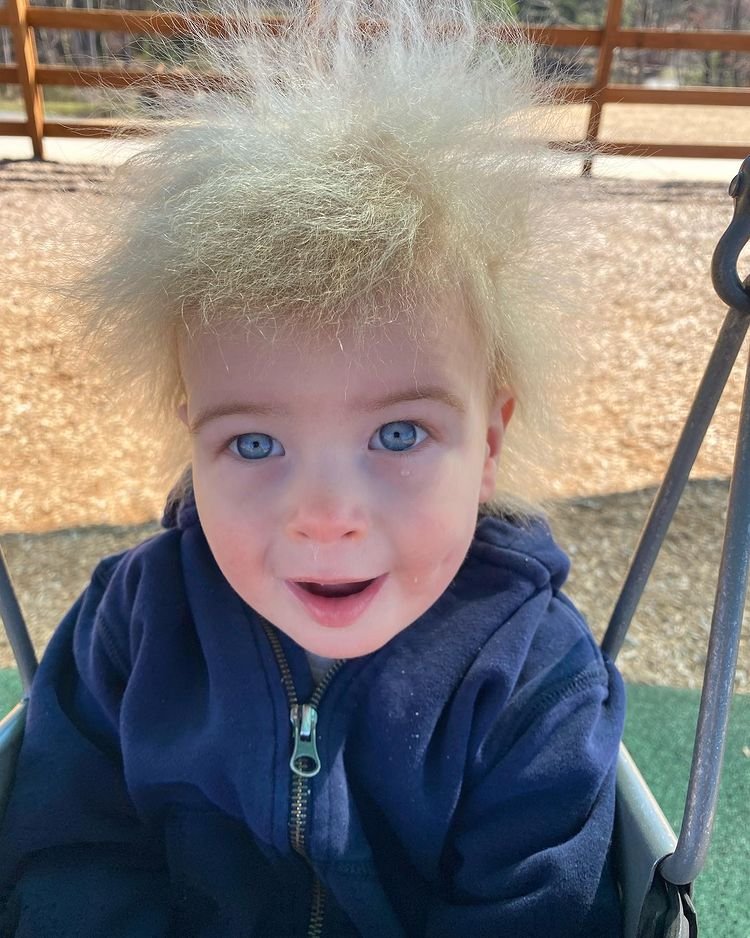 1651032575 660 Menino com Sindrome do Cabelo Impenteavel faz sucesso nas redes