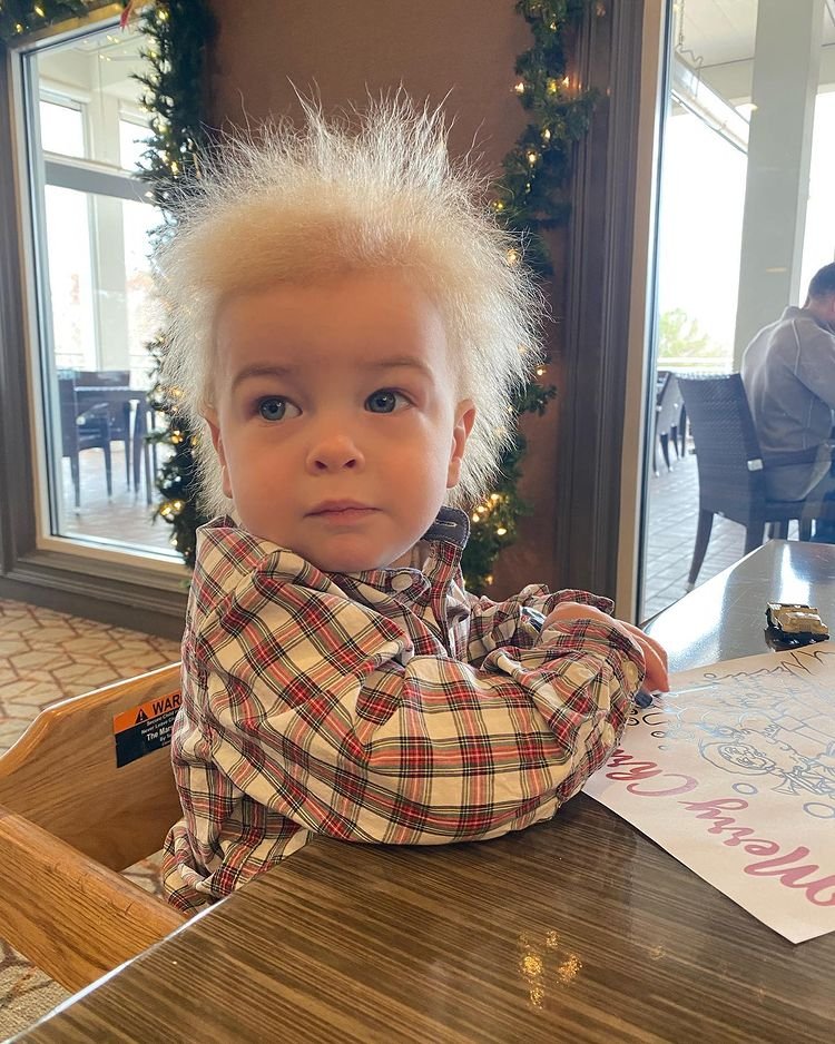 1651032576 287 Menino com Sindrome do Cabelo Impenteavel faz sucesso nas redes