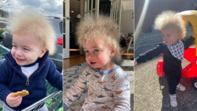 Menino com “Síndrome do Cabelo Impenteável” faz sucesso nas redes sociais