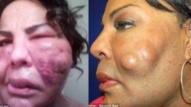 Mulher transgênero injetou cimento no rosto. Veja os acontecimentos 10 anos depois…
