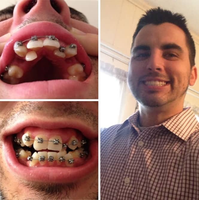 20 transformações quase inacreditáveis de pessoas que tinham dentes fora do lugar