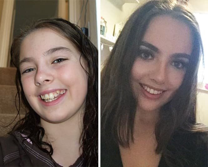 20 transformações quase inacreditáveis de pessoas que tinham dentes fora do lugar