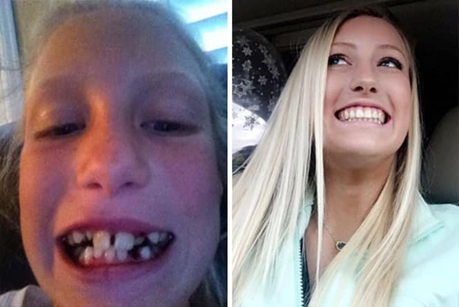 20 transformações quase inacreditáveis de pessoas que tinham dentes fora do lugar