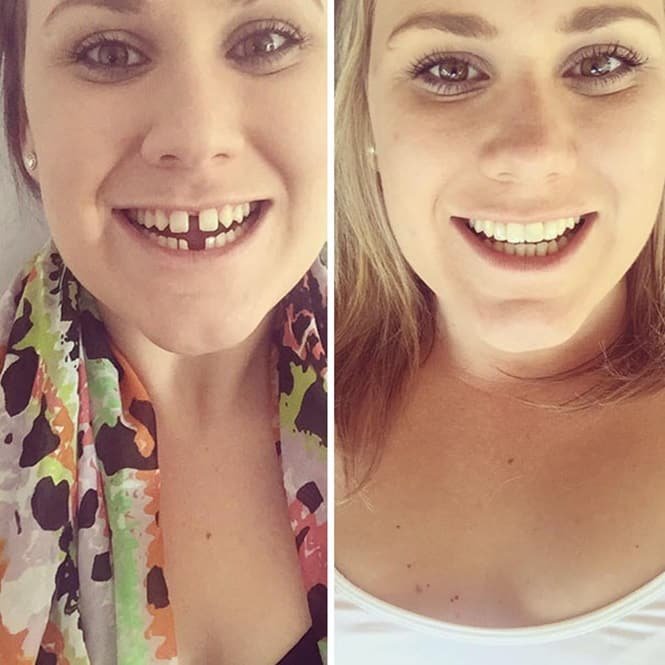 20 transformações quase inacreditáveis de pessoas que tinham dentes fora do lugar