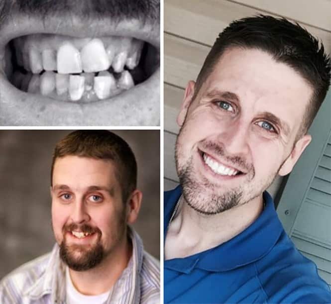 20 transformações quase inacreditáveis de pessoas que tinham dentes fora do lugar