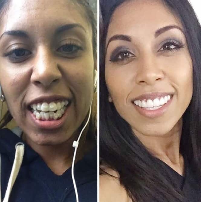 20 transformações quase inacreditáveis de pessoas que tinham dentes fora do lugar