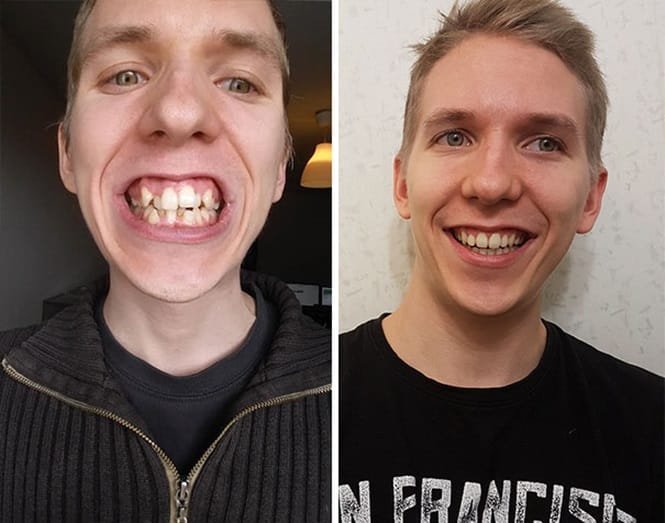 20 transformações quase inacreditáveis de pessoas que tinham dentes fora do lugar