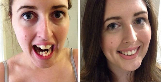 20 transformações quase inacreditáveis de pessoas que tinham dentes fora do lugar