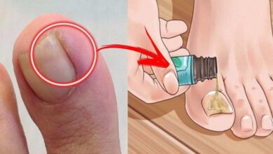 3 receitas naturais para micose de unha (unheiro)