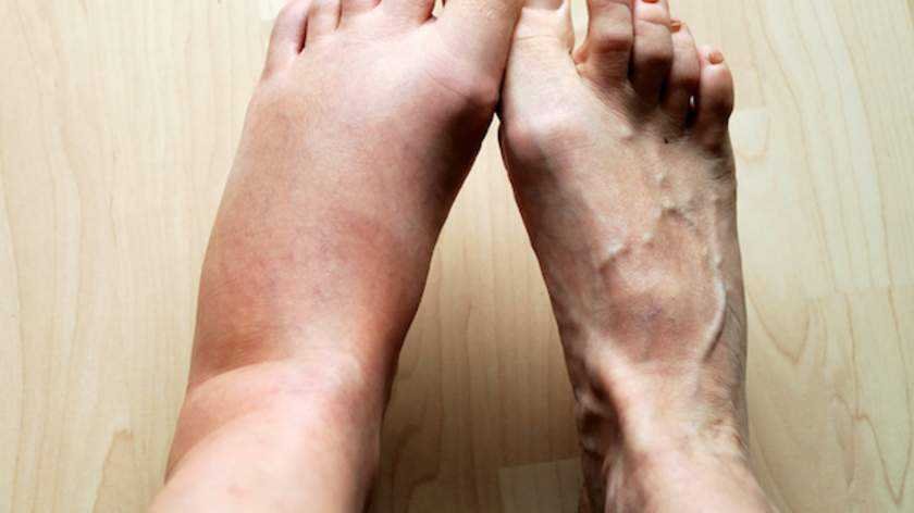 4 Sinais nos seus pés podem indicar se você corre o risco de um infarto ou AVC. Saiba identificar