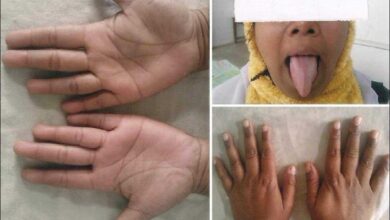 8 sinais de deficiencia de vitamina B12 e como tratar
