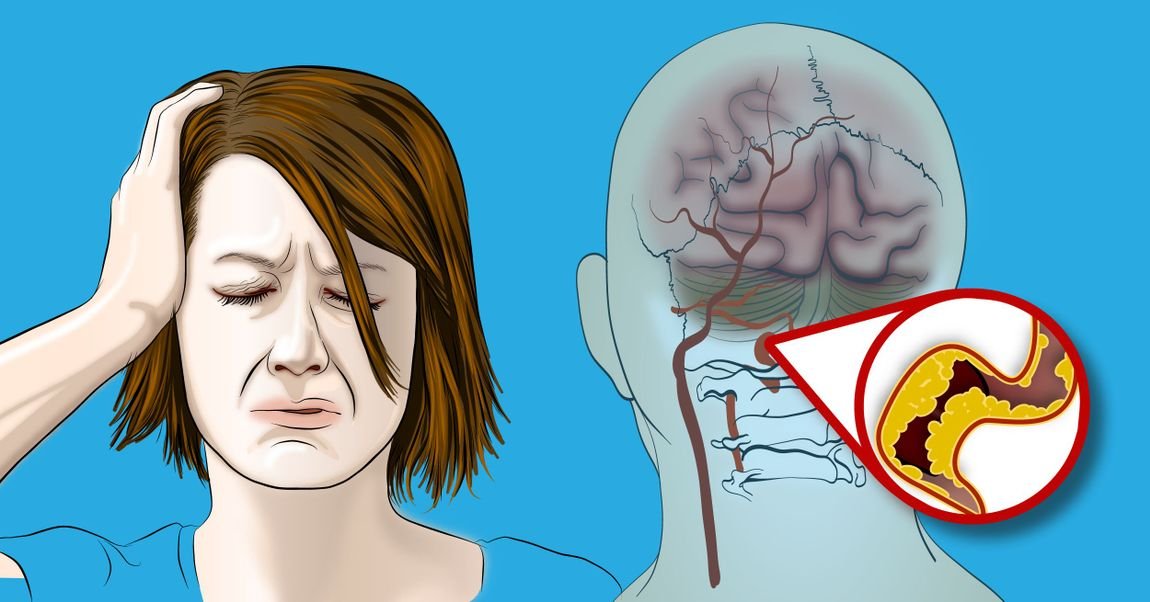 9 sinais incomuns de avc em mulheres que ninguém fala