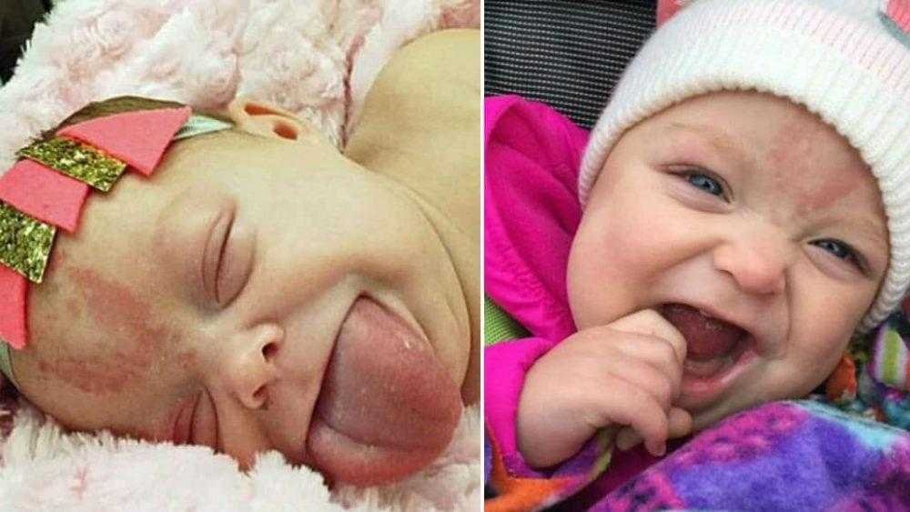 Bebê que nasceu com língua gigante sorri pela 1ª vez após cirurgia Q