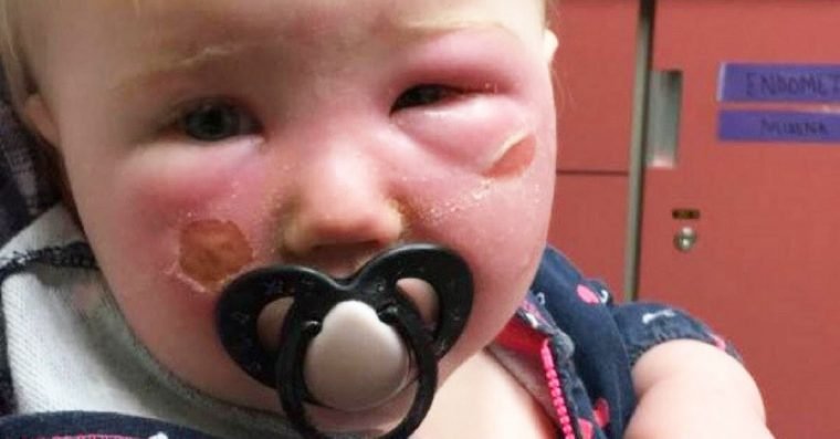 1497566025 674 bebe sofre queimadura de 2o grau em sua face por algo toda a gente utiliza no verao